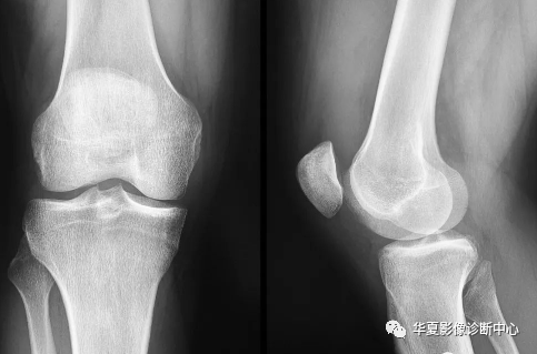 X线上股骨外侧髁深沟征