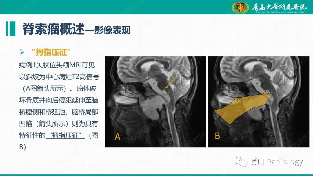 【病例】脊索瘤 VS 软骨肉瘤-17