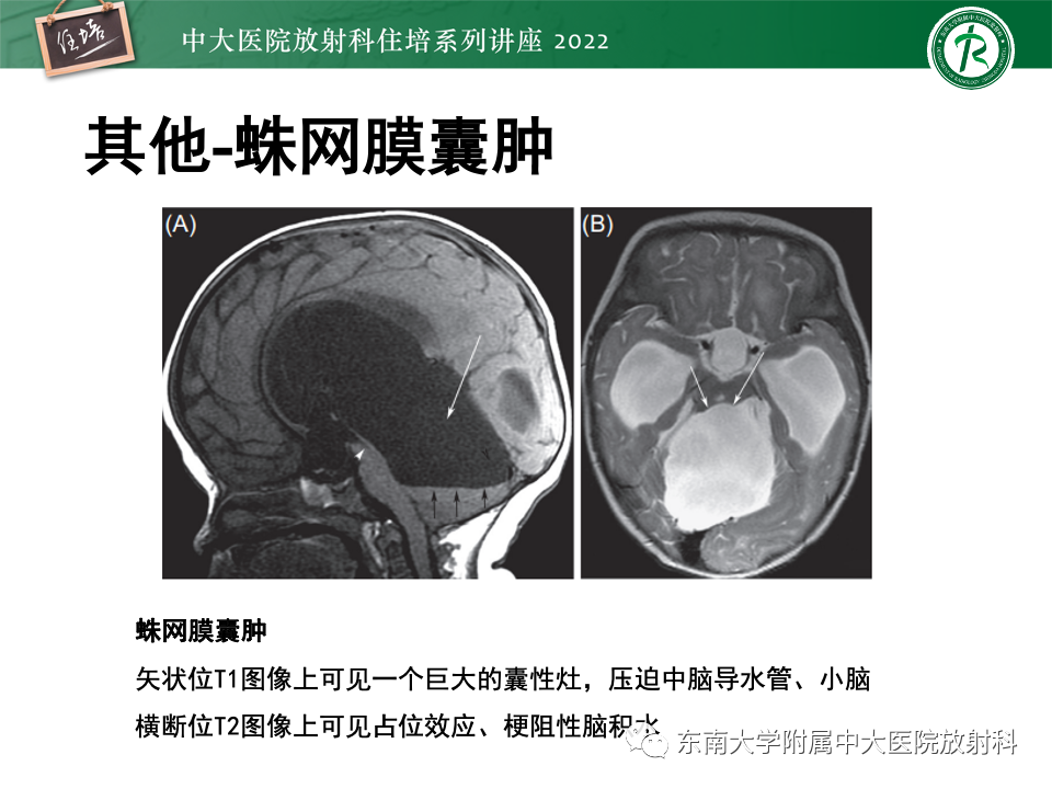 【PPT】松果体区占位性病变的诊断思路-46