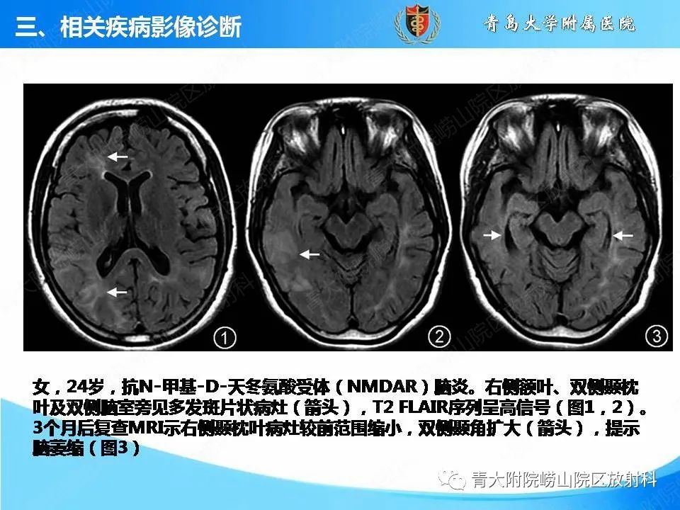 【PPT】自身免疫性脑炎的影像诊断与鉴别-15
