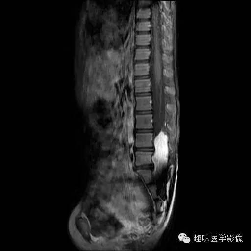 【病例】椎管内恶性神经鞘瘤1例MR影像表现