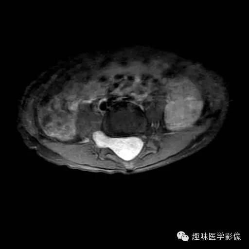 【病例】椎管内恶性神经鞘瘤1例MR影像表现
