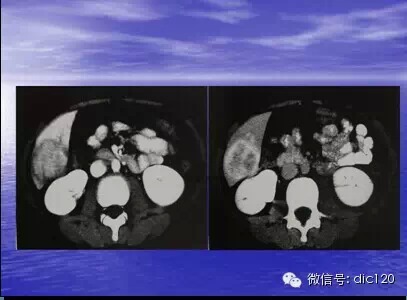 肝脏炎性假瘤的CT诊断