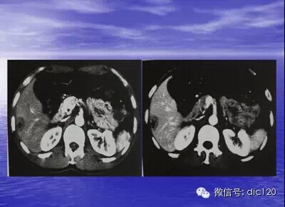 肝脏炎性假瘤的CT诊断