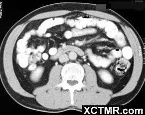 【病例】异位胰腺/迷走胰腺一例
