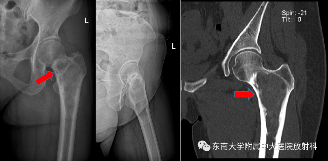 【PPT】骨纤维异常增殖症