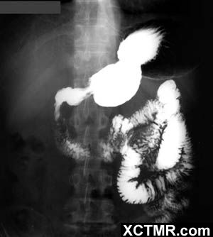 【病例】异位胰腺/迷走胰腺一例