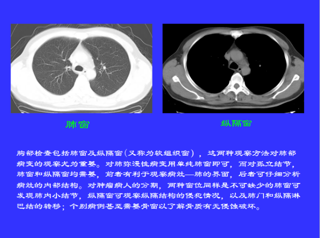 胸部CT阅读与诊断