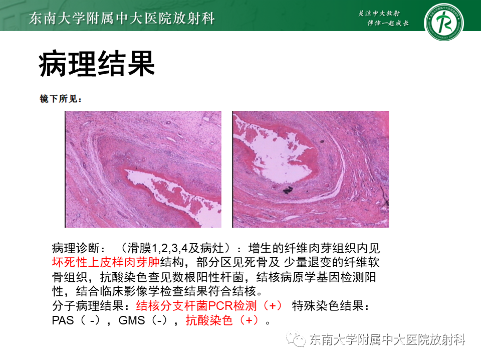 【PPT】膝关节腱鞘巨细胞瘤-27
