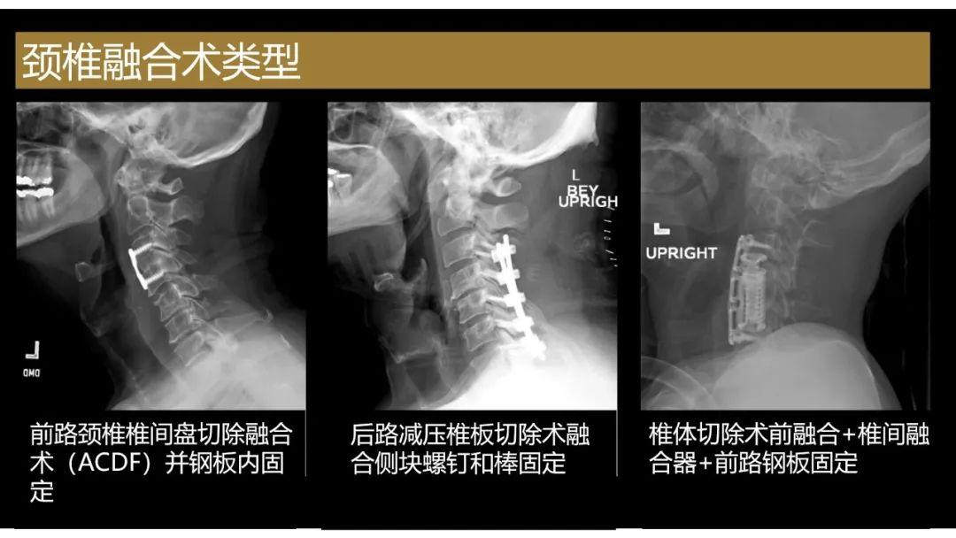 【PPT】评估围手术期脊柱:除了退行性椎间盘疾病和金属植入物的并发症外-11
