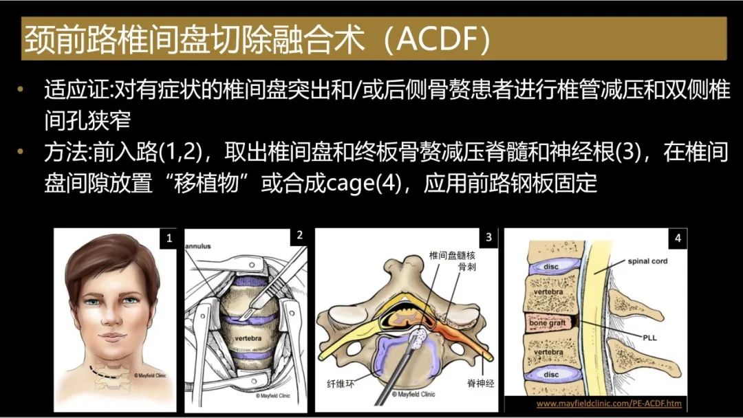 【PPT】评估围手术期脊柱:除了退行性椎间盘疾病和金属植入物的并发症外-13