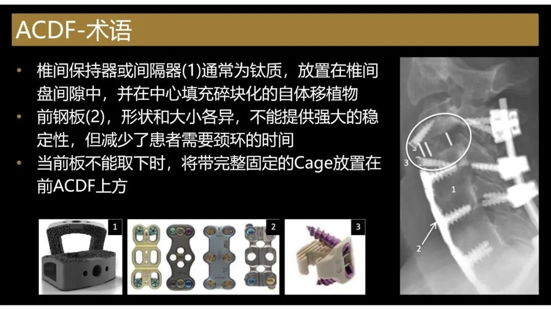 【PPT】评估围手术期脊柱:除了退行性椎间盘疾病和金属植入物的并发症外-15