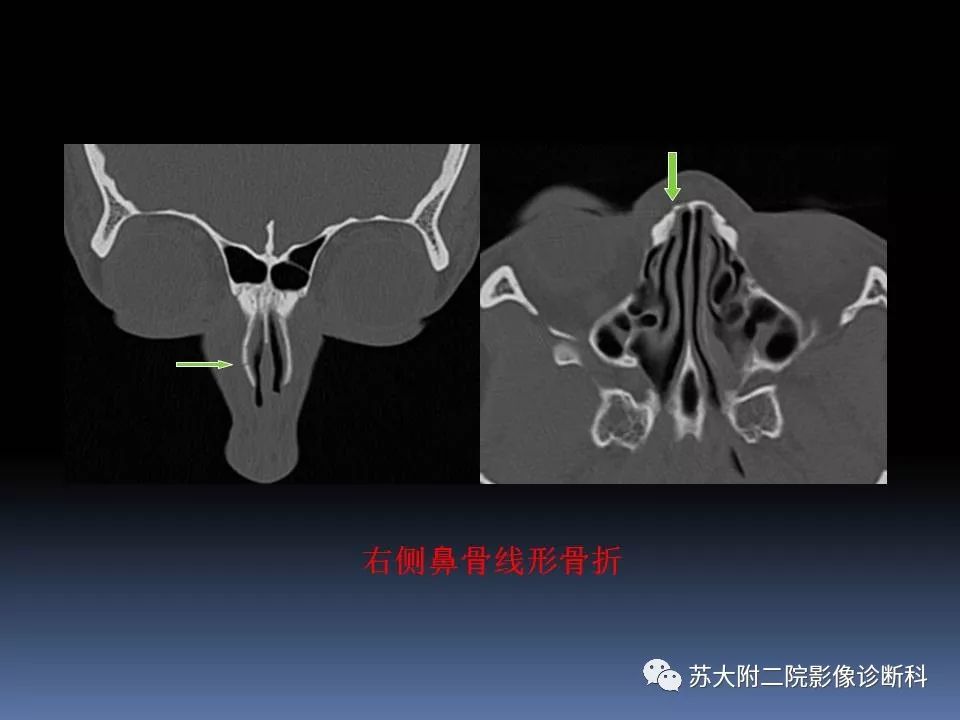 【PPT】鼻骨骨折影像诊断误区-23