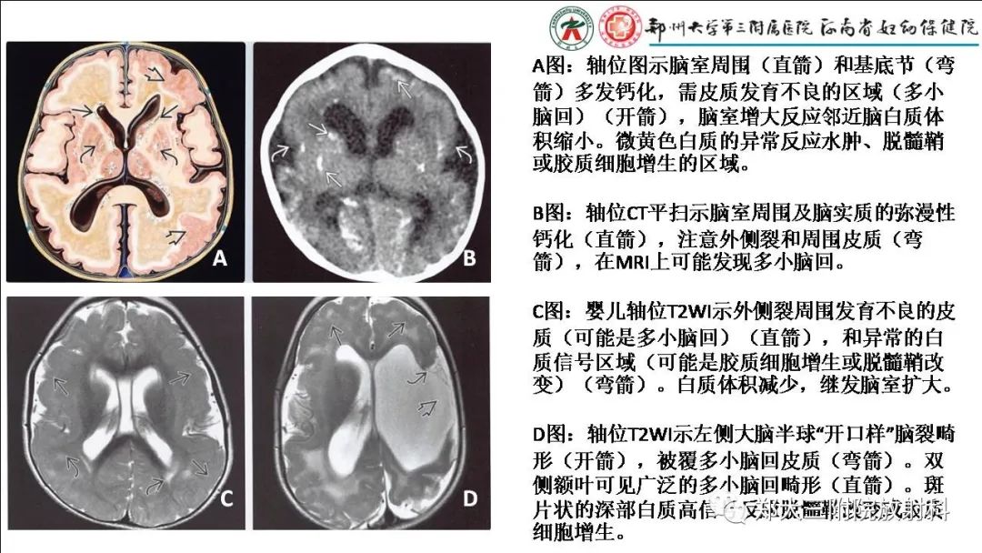 【PPT】多小脑回畸形的影像表现-27