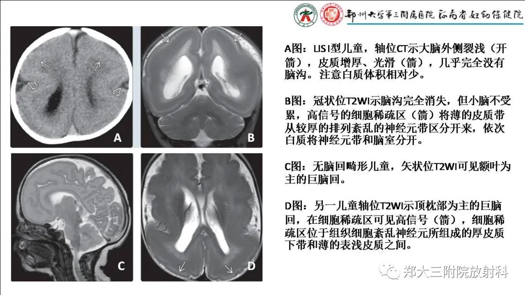 【PPT】多小脑回畸形的影像表现-29