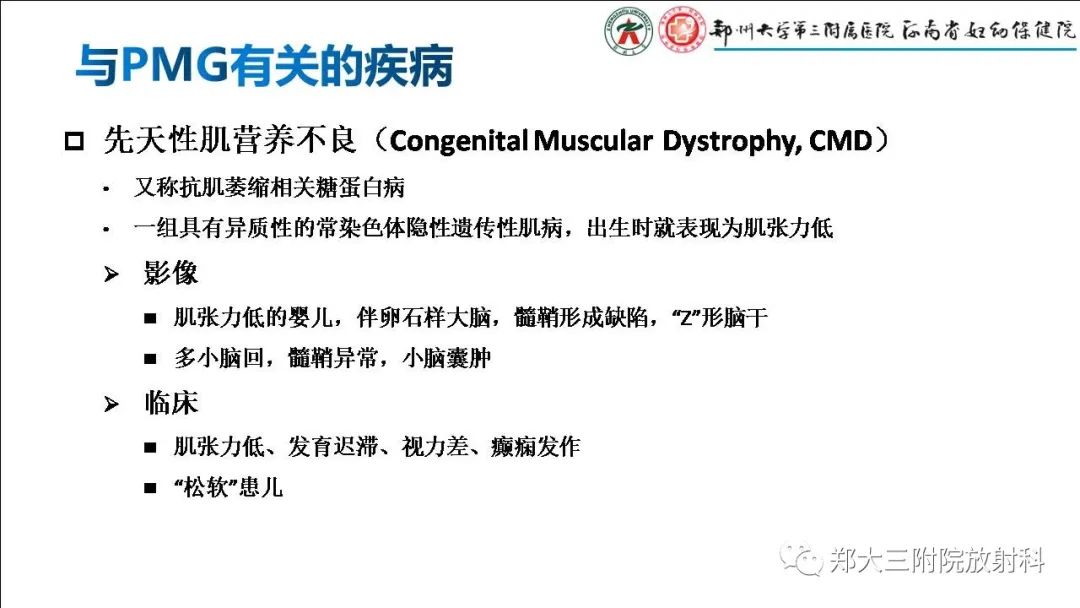 【PPT】多小脑回畸形的影像表现-30