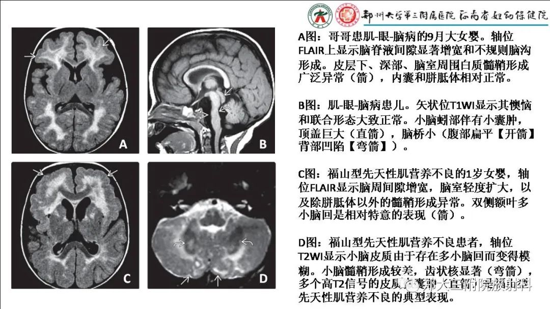 【PPT】多小脑回畸形的影像表现-32