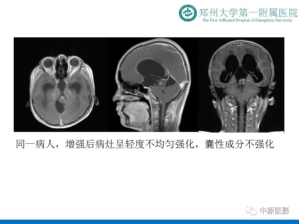 【PPT】松果体区肿瘤的MRI影像分析-17