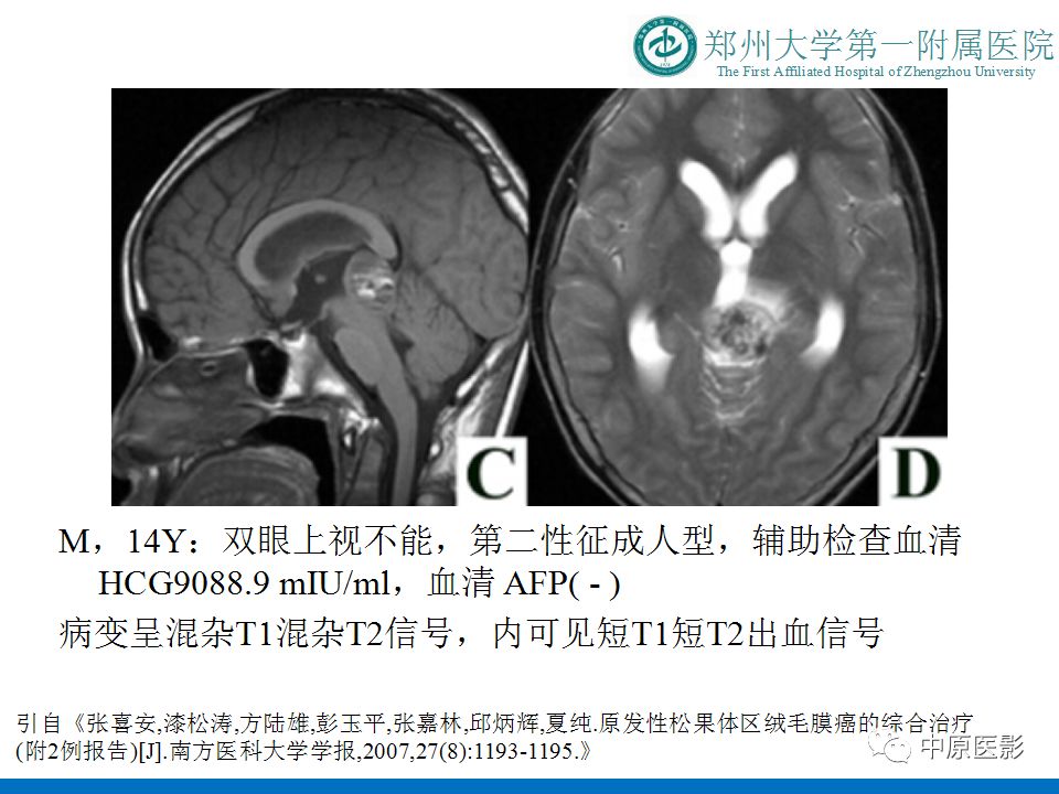 【PPT】松果体区肿瘤的MRI影像分析-22