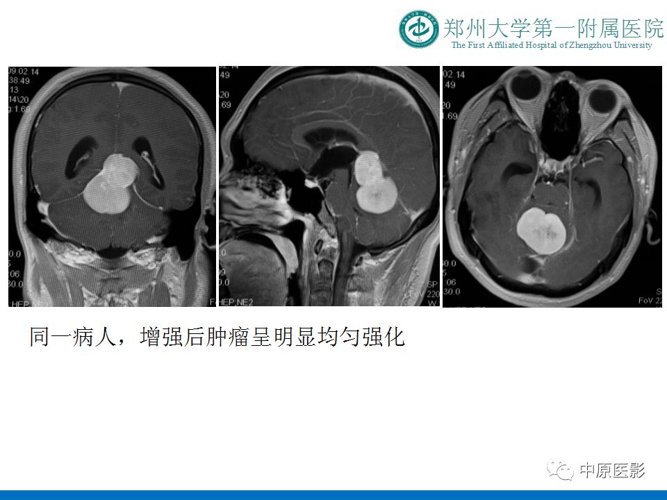 【PPT】松果体区肿瘤的MRI影像分析-44