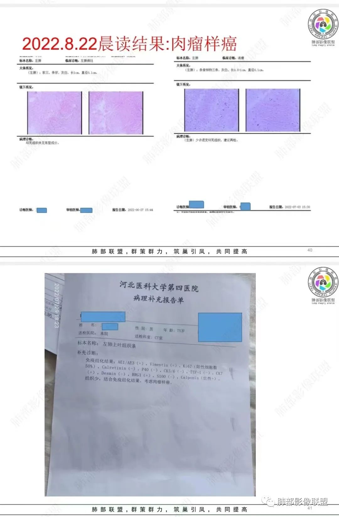 【病例】肺部硕大块影一定想到它！-57
