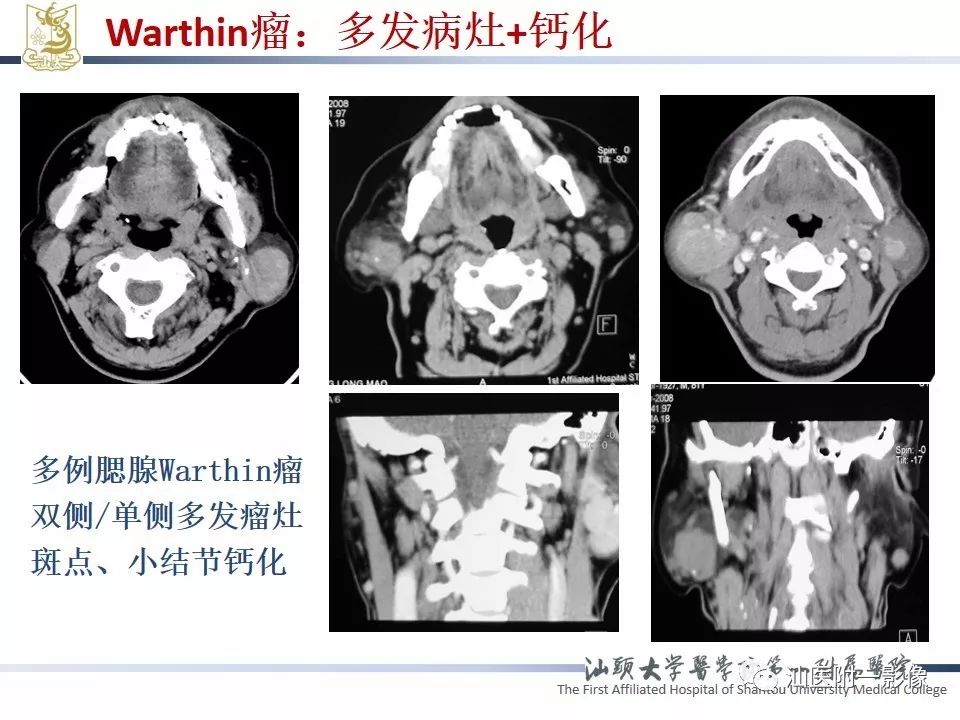 【PPT】腮腺病变CT诊断-49
