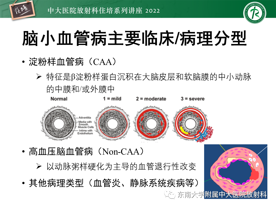 【PPT】脑小血管病概念、影像维度及其深度学习进展-5