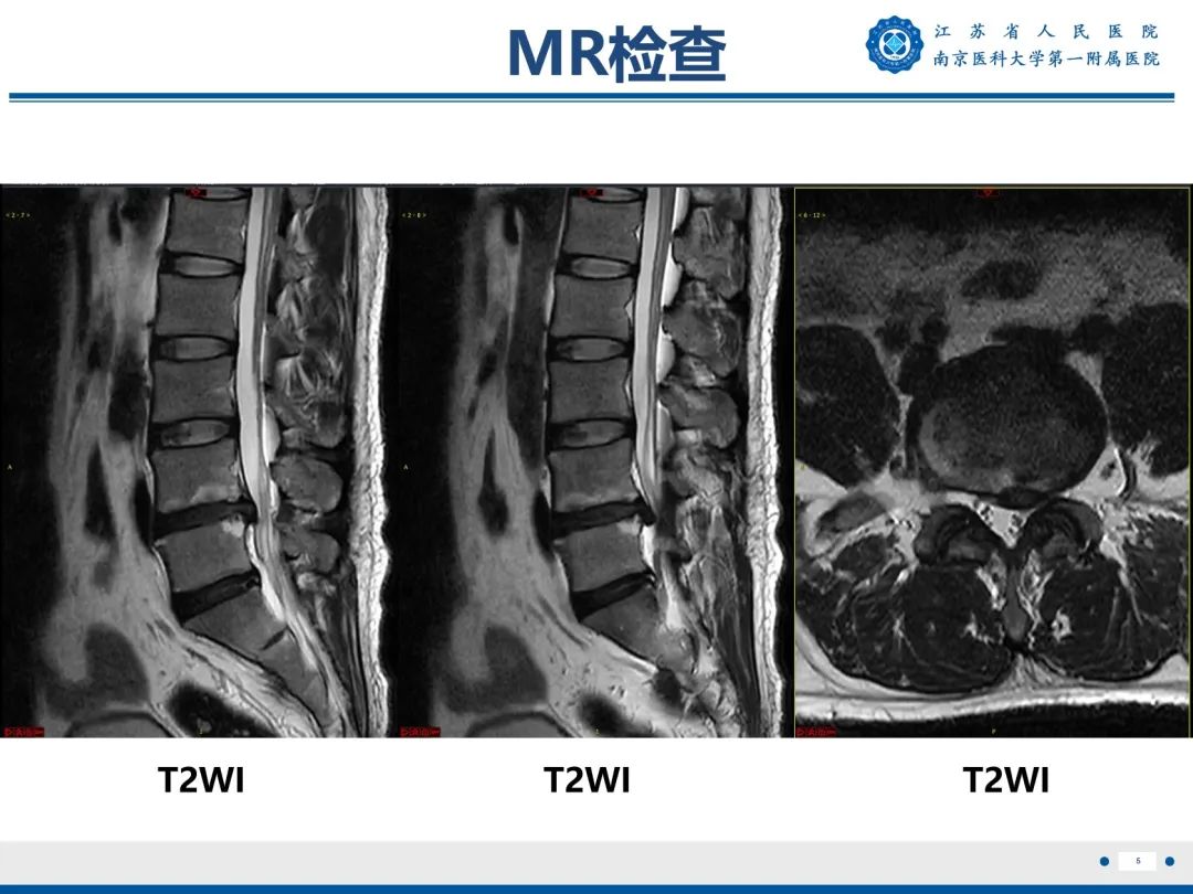 【PPT】终板炎-6