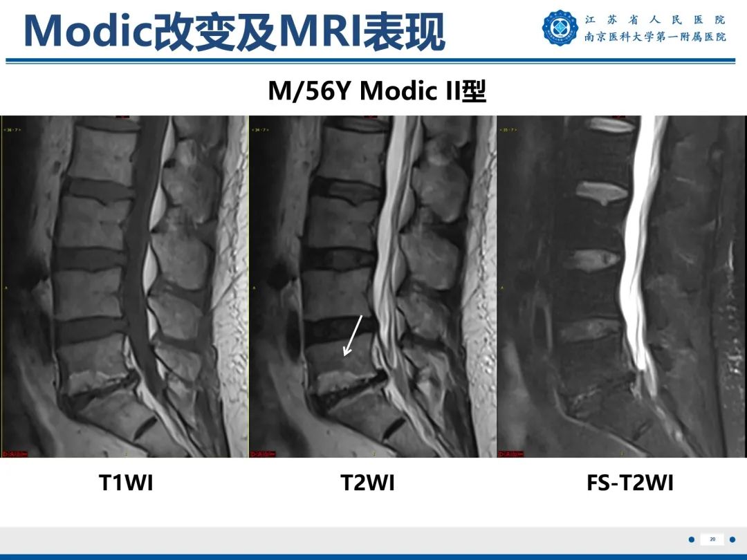 【PPT】终板炎-21