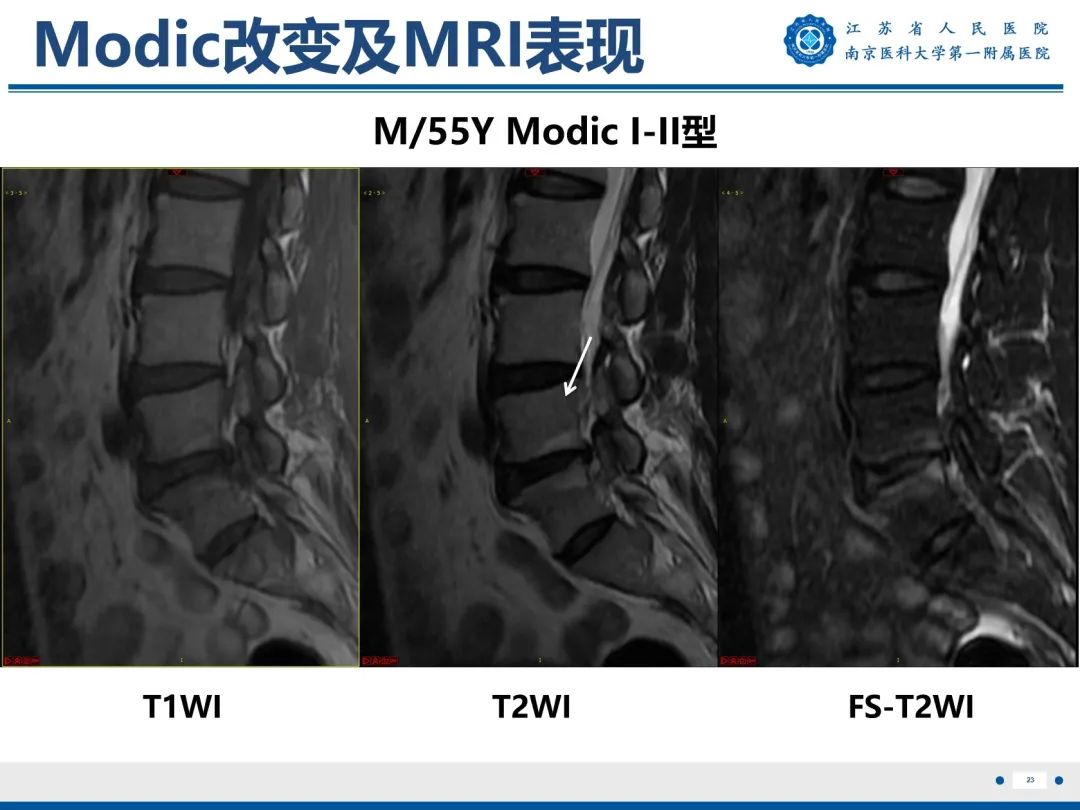 【PPT】终板炎-24