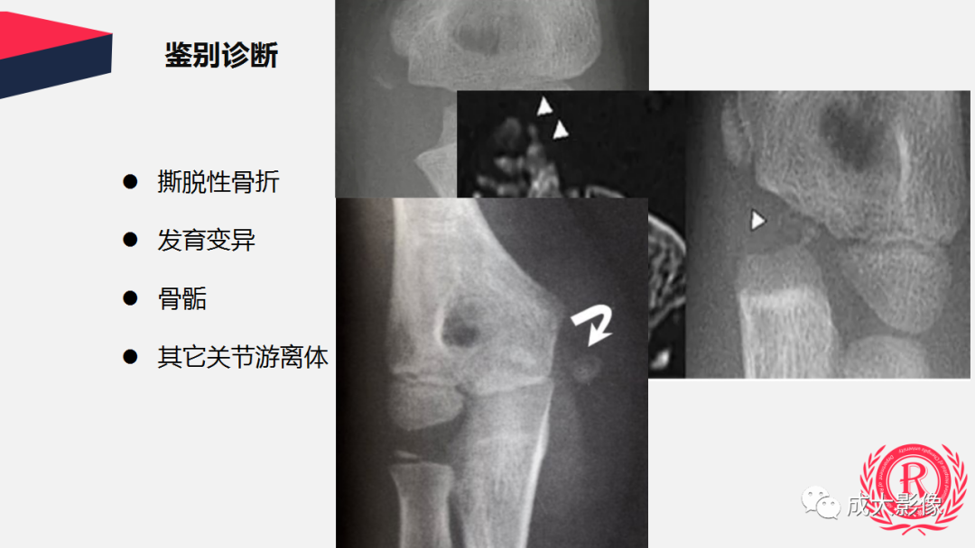 【PPT】剥脱性骨软骨炎-25