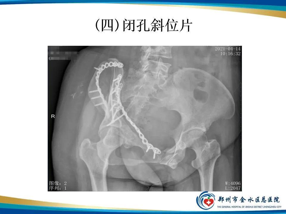 【PPT】骨盆拍片技术与临床意义-20