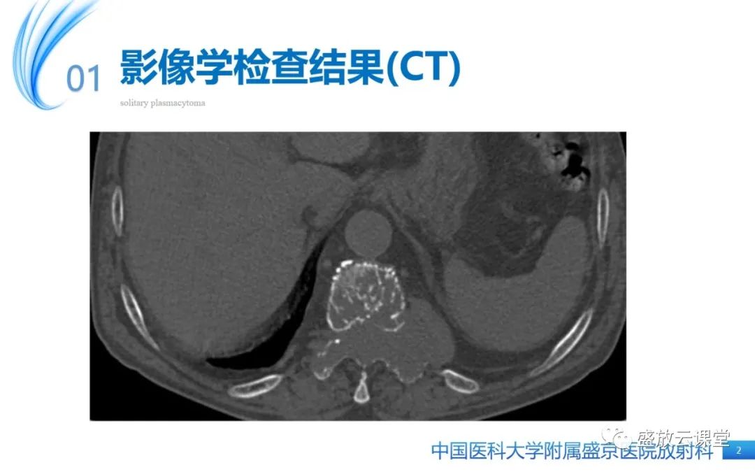 【PPT】孤立性浆细胞瘤-2
