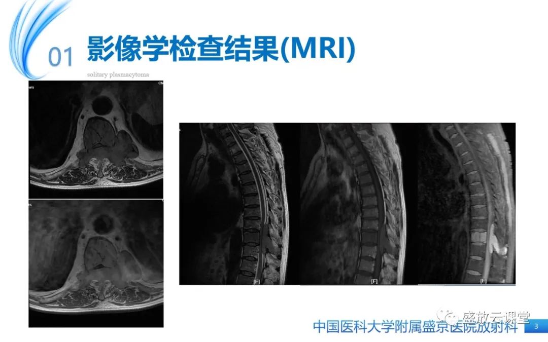 【PPT】孤立性浆细胞瘤-3