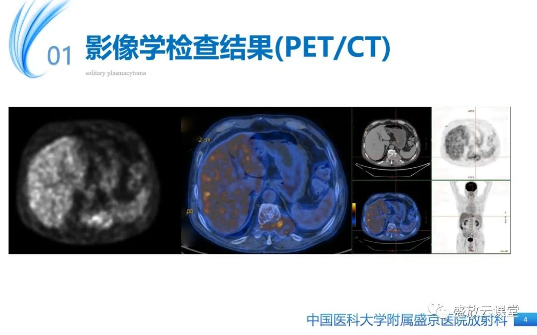 【PPT】孤立性浆细胞瘤-4