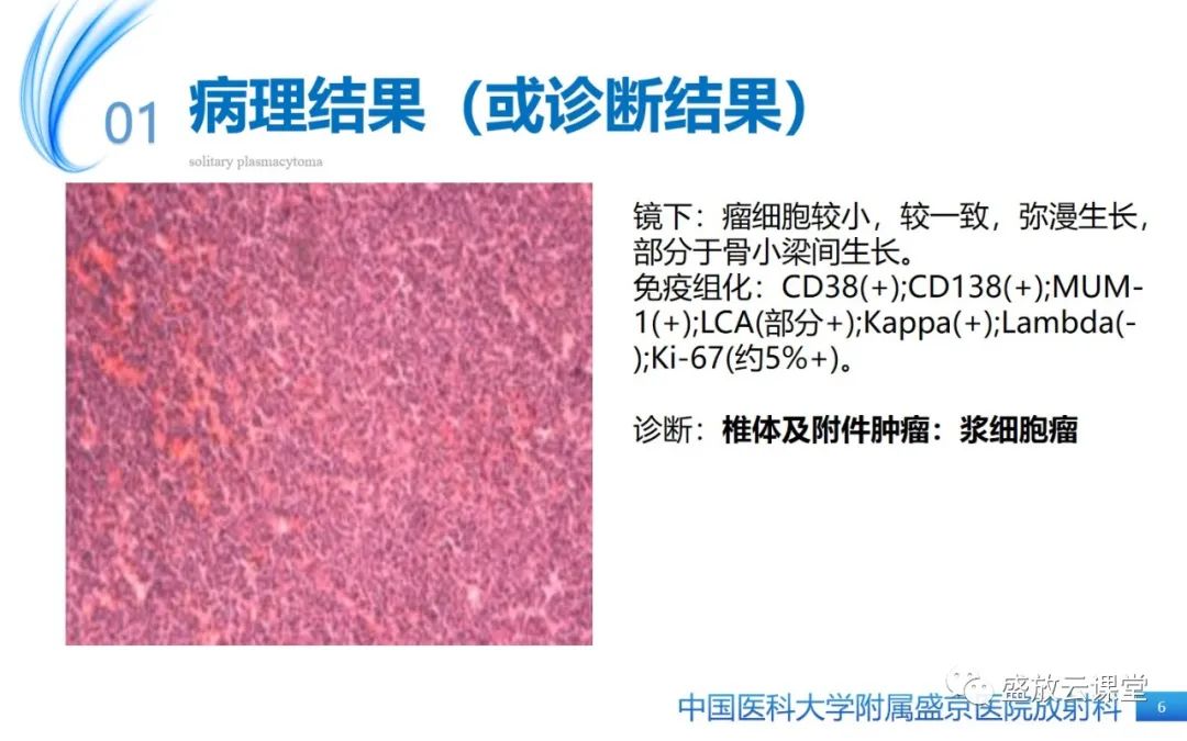 【PPT】孤立性浆细胞瘤-6