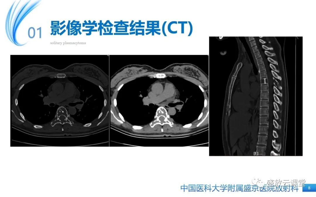 【PPT】孤立性浆细胞瘤-8