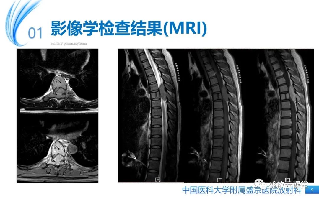 【PPT】孤立性浆细胞瘤-9