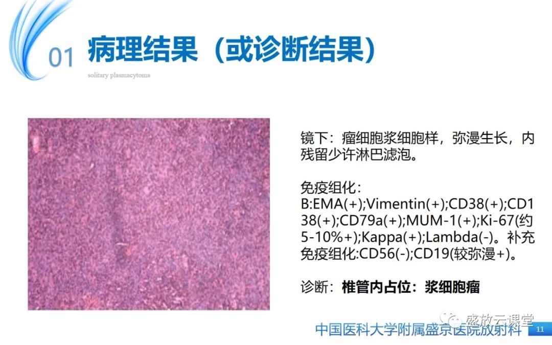 【PPT】孤立性浆细胞瘤-10