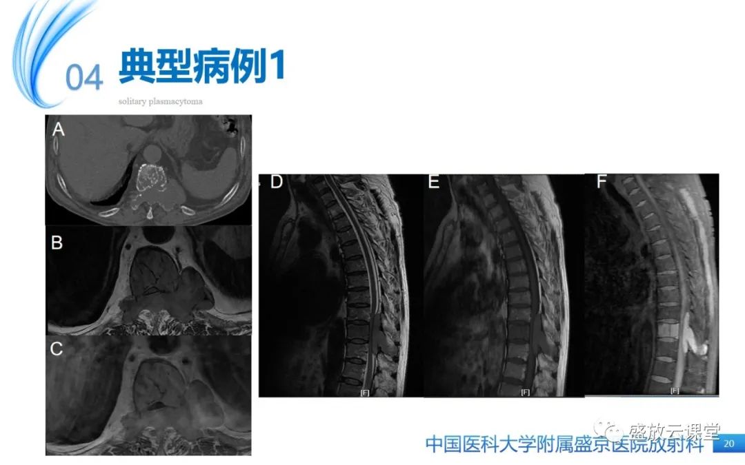【PPT】孤立性浆细胞瘤-19