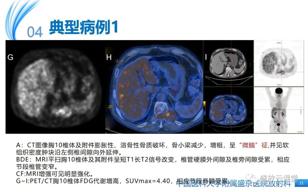 【PPT】孤立性浆细胞瘤-20