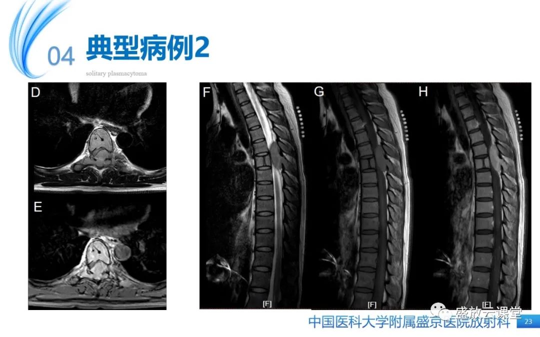 【PPT】孤立性浆细胞瘤-22