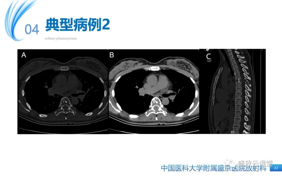 【PPT】孤立性浆细胞瘤-21