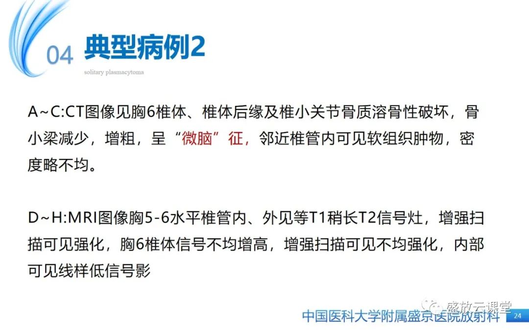 【PPT】孤立性浆细胞瘤-23
