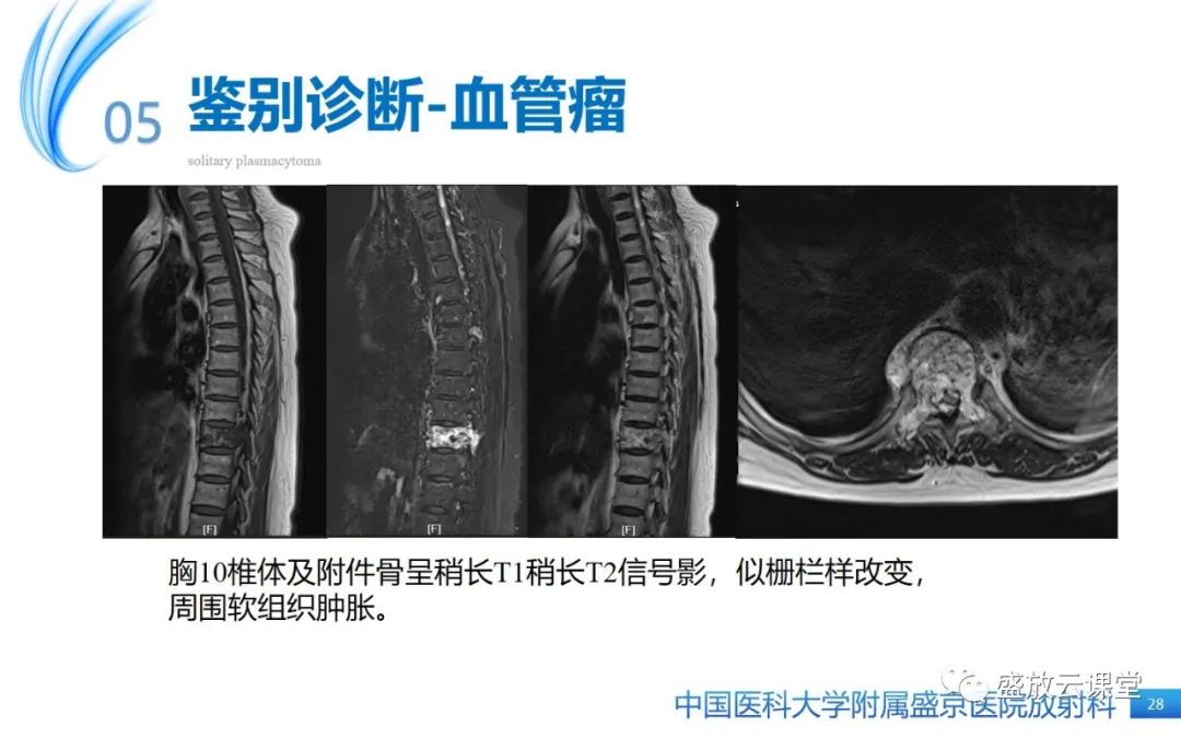 【PPT】孤立性浆细胞瘤-27