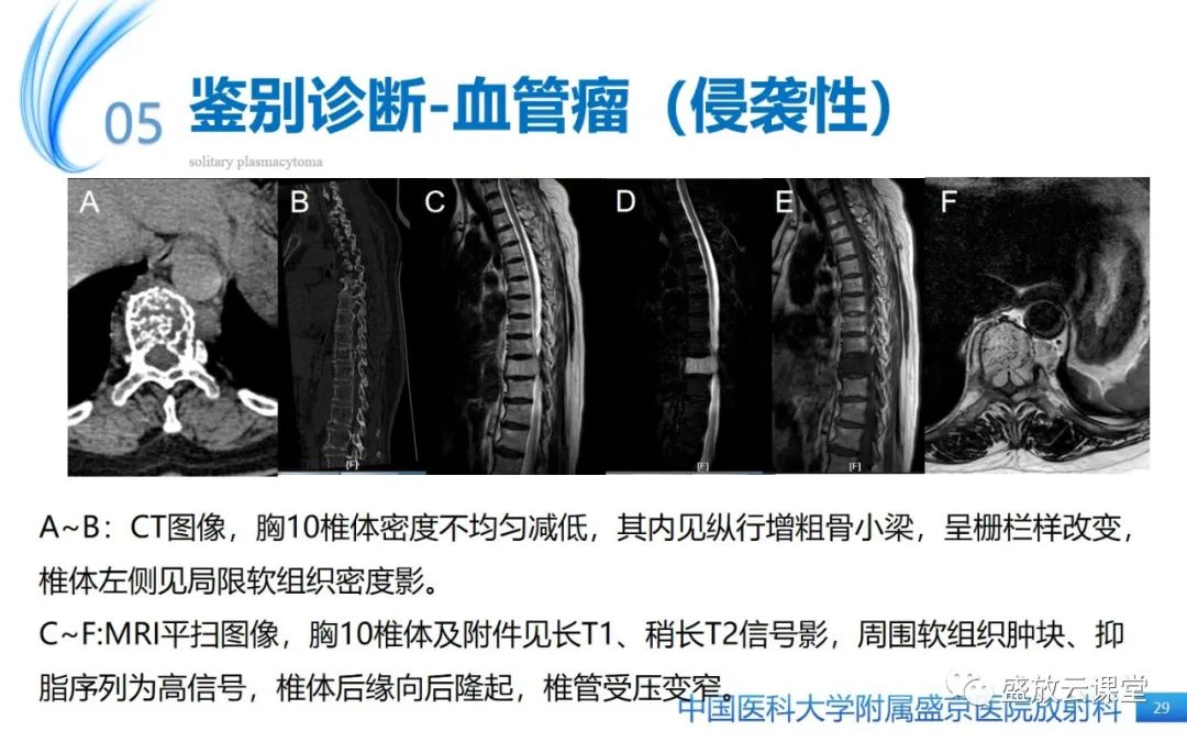 【PPT】孤立性浆细胞瘤-28