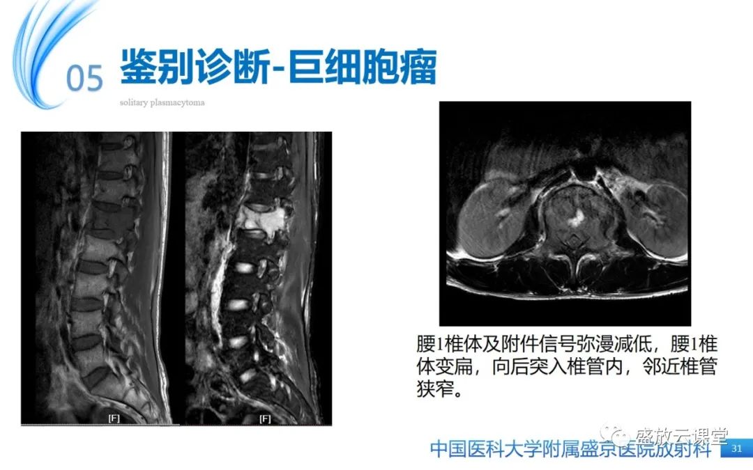 【PPT】孤立性浆细胞瘤-30