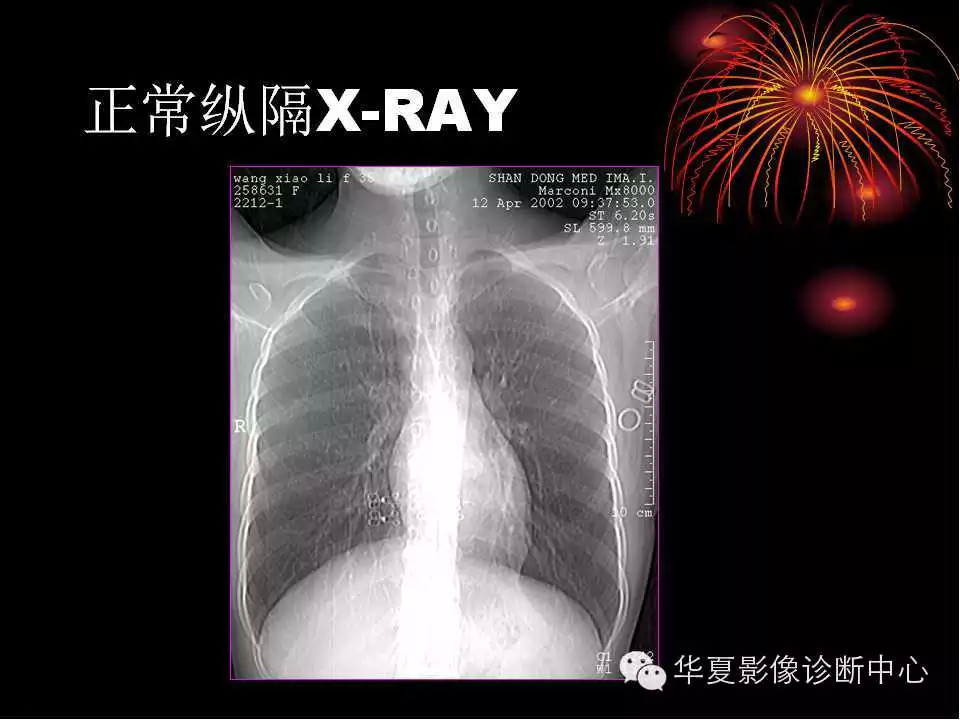 肺与纵隔的影像诊断