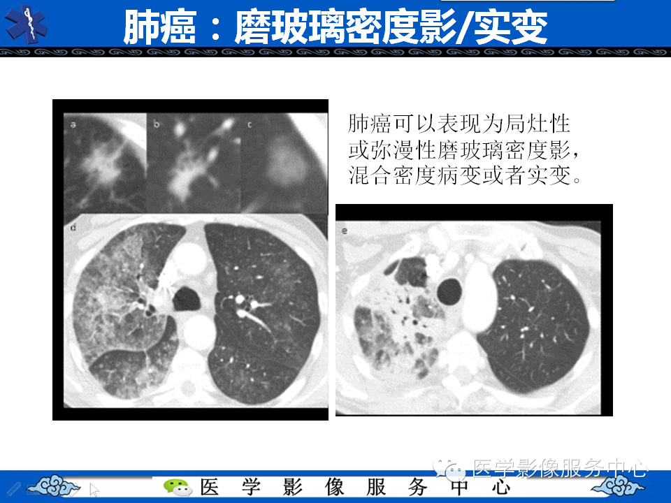 【考考你】哪一个不是肺癌？（共12组病例）