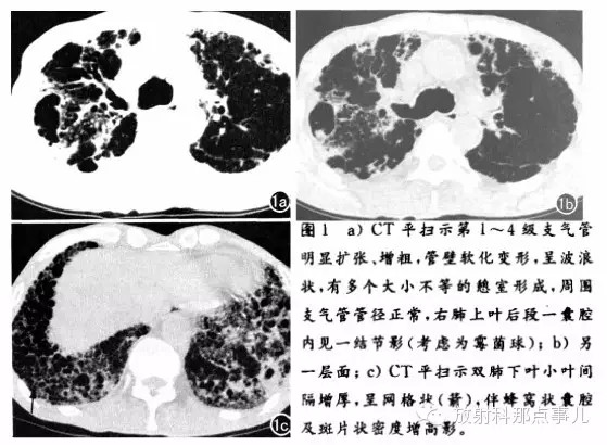 【病例学习】气管支气管巨大症（TBM）